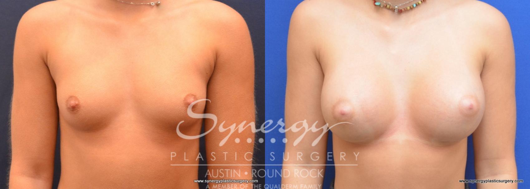 Before & After Breast Augmentation Case 733 View #1 View in Austin, TX