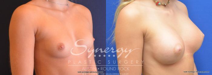 Before & After Breast Augmentation Case 733 View #2 View in Austin, TX