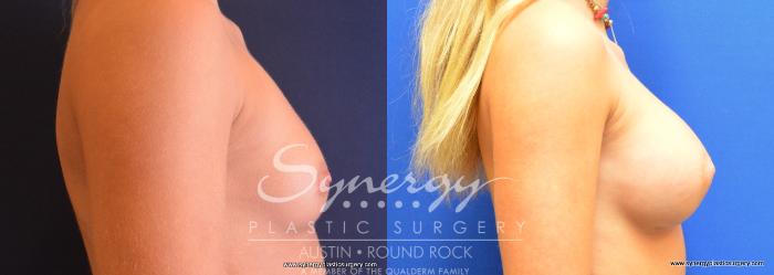Before & After Breast Augmentation Case 733 View #3 View in Austin, TX