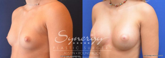 Before & After Breast Augmentation Case 733 View #4 View in Austin, TX