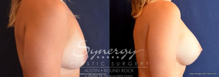 Before & After Breast Augmentation Case 734 View #2 View in Austin, TX