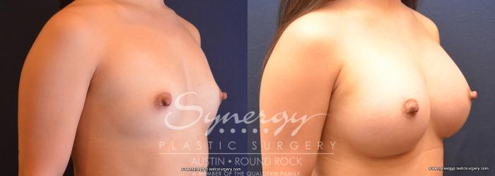 Before & After Breast Augmentation Case 737 View #3 View in Austin, TX
