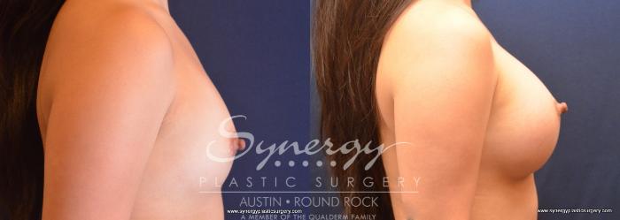 Before & After Breast Augmentation Case 737 View #4 View in Austin, TX