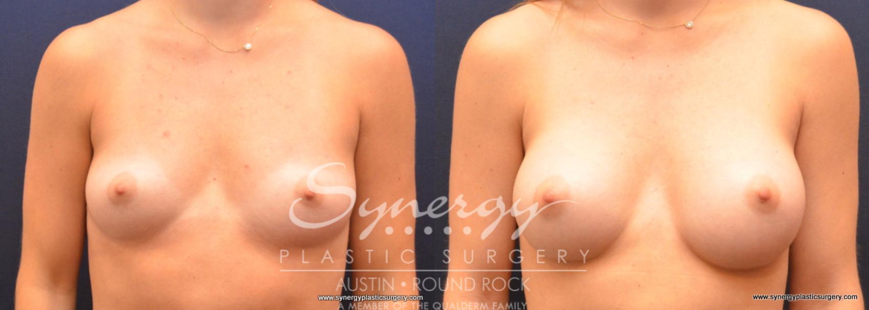 Before & After Breast Augmentation Case 738 View #1 View in Austin, TX