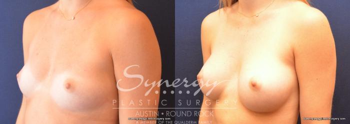 Before & After Breast Augmentation Case 738 View #2 View in Austin, TX