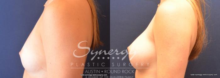 Before & After Breast Augmentation Case 738 View #3 View in Austin, TX