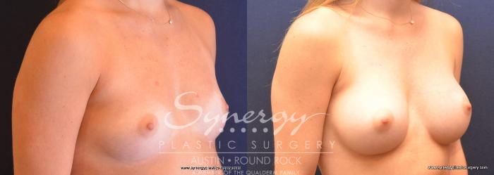 Before & After Breast Augmentation Case 738 View #4 View in Austin, TX