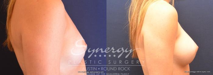 Before & After Breast Augmentation Case 738 View #5 View in Austin, TX