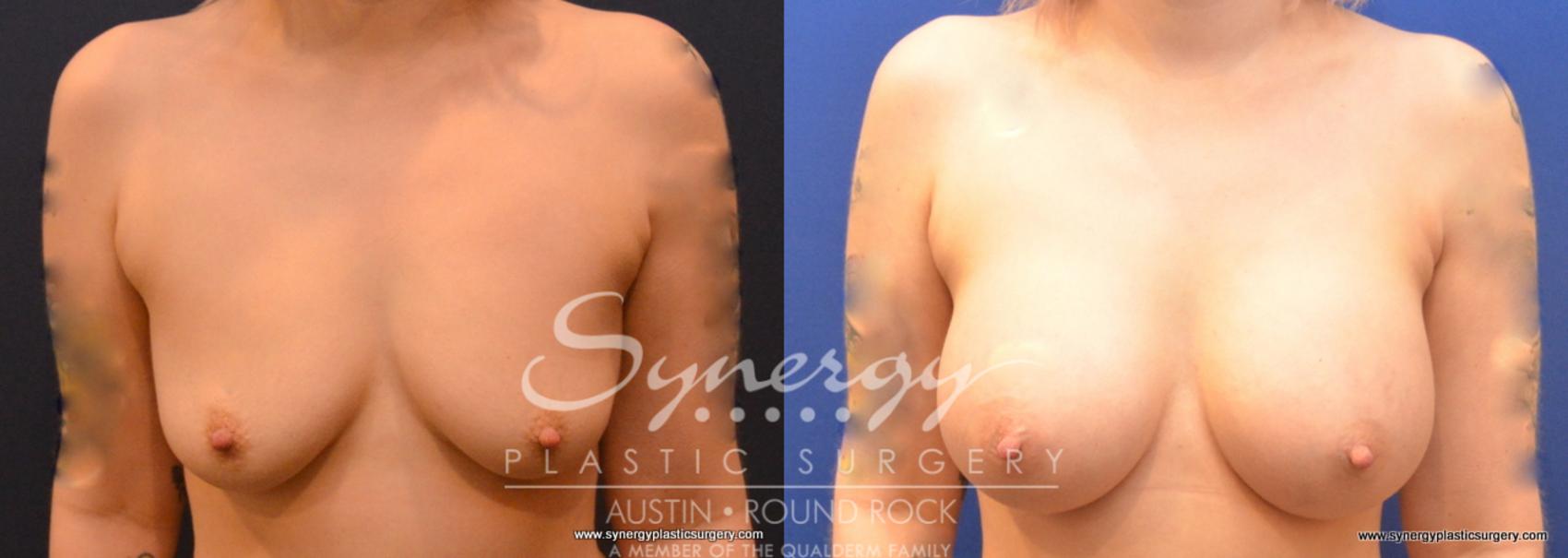 Before & After Breast Augmentation Case 741 View #1 View in Austin, TX