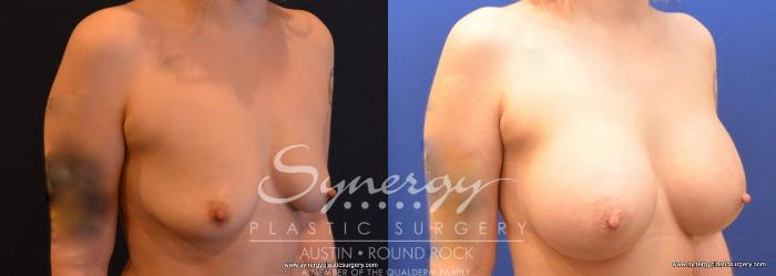 Before & After Breast Augmentation Case 741 View #2 View in Austin, TX