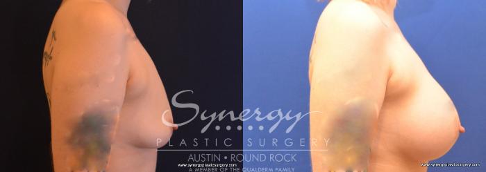 Before & After Breast Augmentation Case 741 View #3 View in Austin, TX