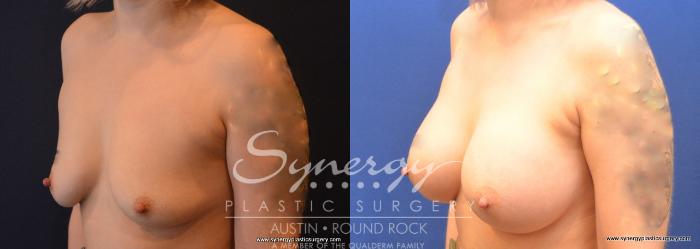 Before & After Breast Augmentation Case 741 View #4 View in Austin, TX