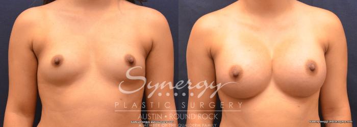 Before & After Breast Augmentation Case 744 View #1 View in Austin, TX