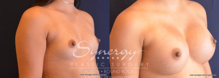 Before & After Breast Augmentation Case 744 View #4 View in Austin, TX