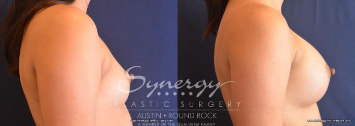 Before & After Breast Augmentation Case 744 View #5 View in Austin, TX