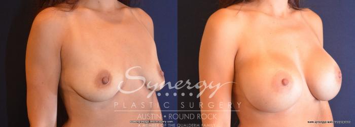 Before & After Breast Augmentation Case 745 View #4 View in Austin, TX