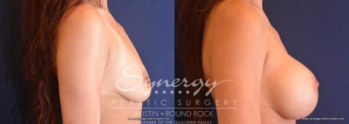 Before & After Breast Augmentation Case 745 View #5 View in Austin, TX