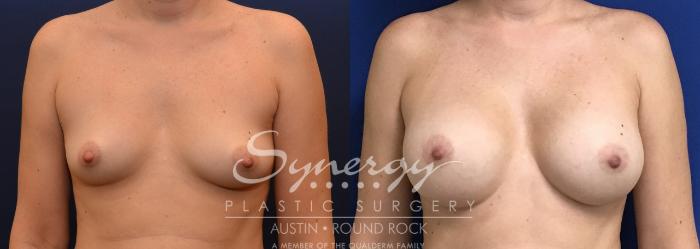 Before & After Breast Augmentation Case 747 View #1 View in Austin, TX