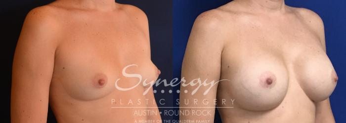 Before & After Breast Augmentation Case 747 View #2 View in Austin, TX