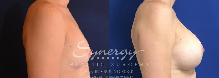 Before & After Breast Augmentation Case 747 View #3 View in Austin, TX