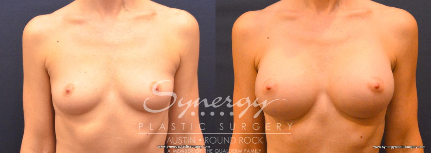 Before & After Breast Augmentation Case 749 View #1 View in Austin, TX