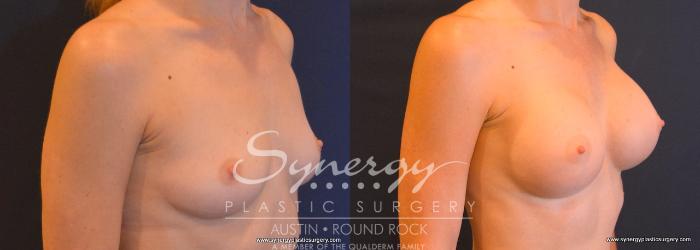Before & After Breast Augmentation Case 749 View #2 View in Austin, TX