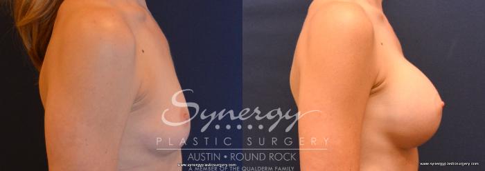 Before & After Breast Augmentation Case 749 View #3 View in Austin, TX