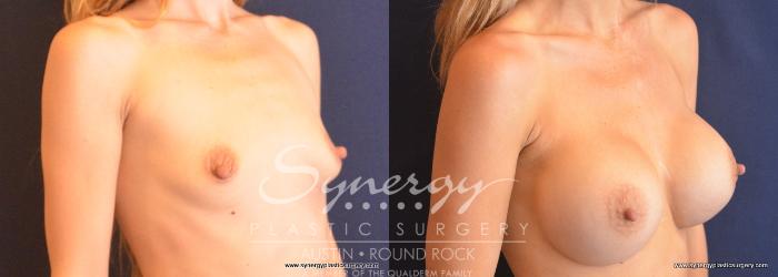 Before & After Breast Augmentation Case 750 View #2 View in Austin, TX