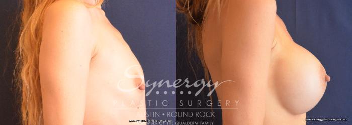 Before & After Breast Augmentation Case 750 View #3 View in Austin, TX