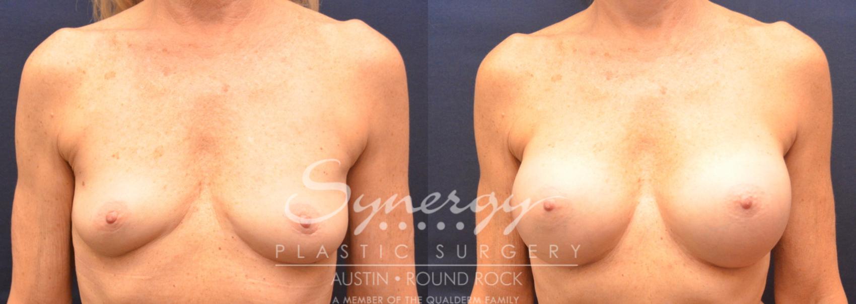 Before & After Breast Augmentation Case 751 View #1 View in Austin, TX