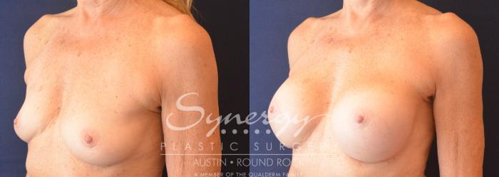 Before & After Breast Augmentation Case 751 View #2 View in Austin, TX