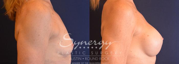 Before & After Breast Augmentation Case 751 View #3 View in Austin, TX