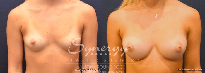 Before & After Breast Augmentation Case 754 View #1 View in Austin, TX