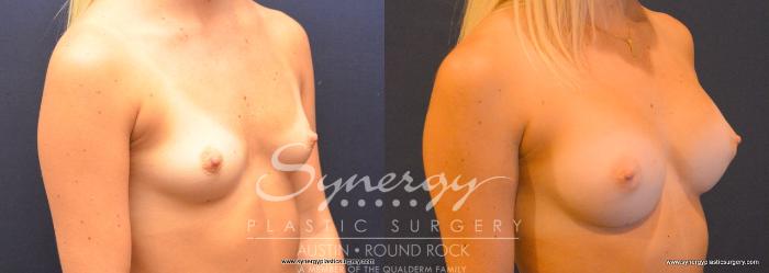 Before & After Breast Augmentation Case 754 View #2 View in Austin, TX