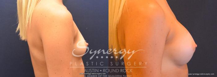 Before & After Breast Augmentation Case 754 View #3 View in Austin, TX