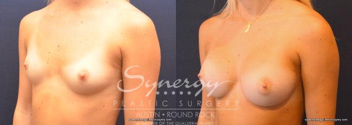 Before & After Breast Augmentation Case 754 View #4 View in Austin, TX