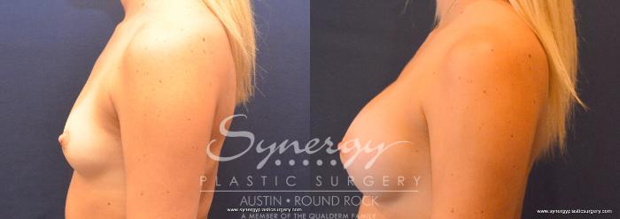 Before & After Breast Augmentation Case 754 View #5 View in Austin, TX