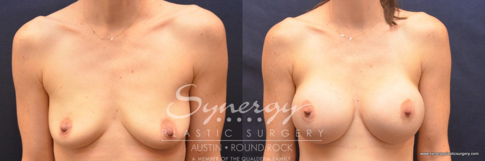 Before & After Breast Augmentation Case 755 View #1 View in Austin, TX