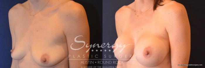Before & After Breast Augmentation Case 755 View #2 View in Austin, TX