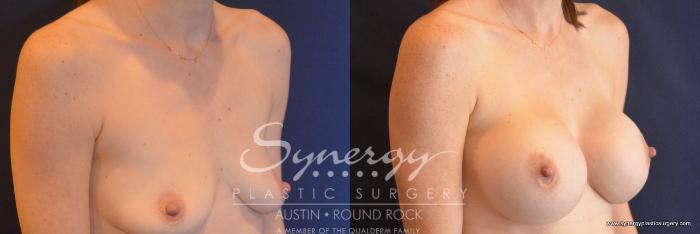 Before & After Breast Augmentation Case 755 View #4 View in Austin, TX