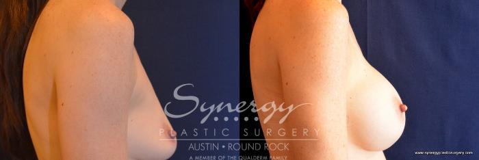 Before & After Breast Augmentation Case 755 View #5 View in Austin, TX