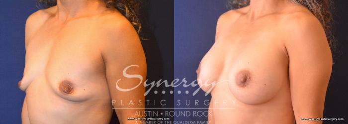 Before & After Breast Augmentation Case 756 View #2 View in Austin, TX