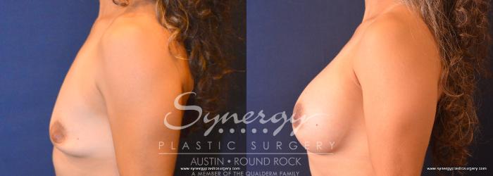 Before & After Breast Augmentation Case 756 View #3 View in Austin, TX