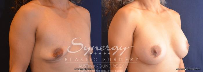 Before & After Breast Augmentation Case 756 View #4 View in Austin, TX