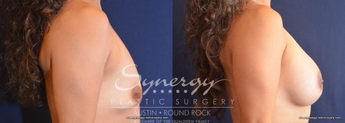 Before & After Breast Augmentation Case 756 View #5 View in Austin, TX