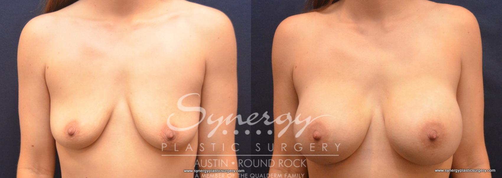 Before & After Breast Augmentation Case 757 View #1 View in Austin, TX