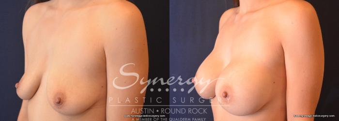 Before & After Breast Augmentation Case 757 View #2 View in Austin, TX