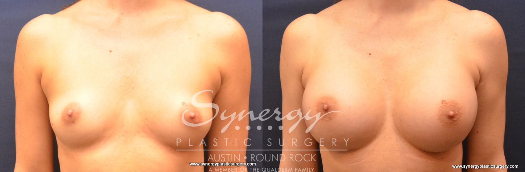 Before & After Breast Augmentation Case 786 View #1 View in Austin, TX
