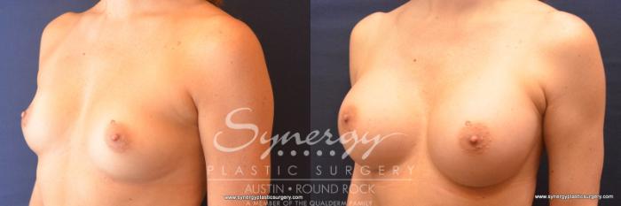 Before & After Breast Augmentation Case 786 View #2 View in Austin, TX