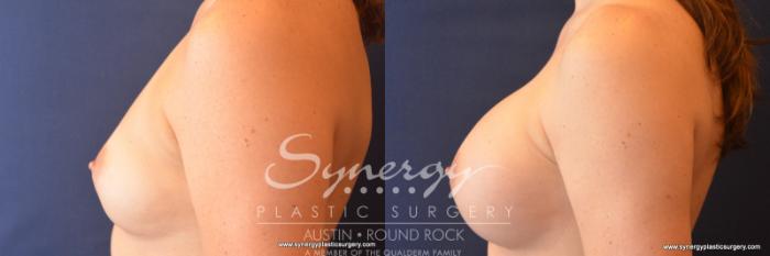 Before & After Breast Augmentation Case 786 View #3 View in Austin, TX